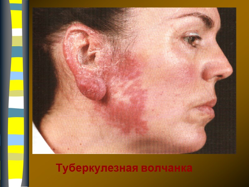 Туберкулезная волчанка